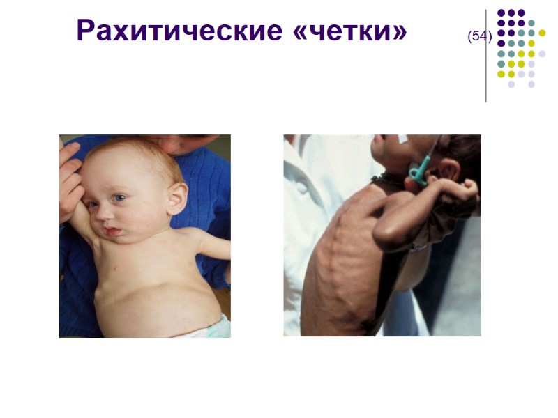 Рахитические «четки»       (54)